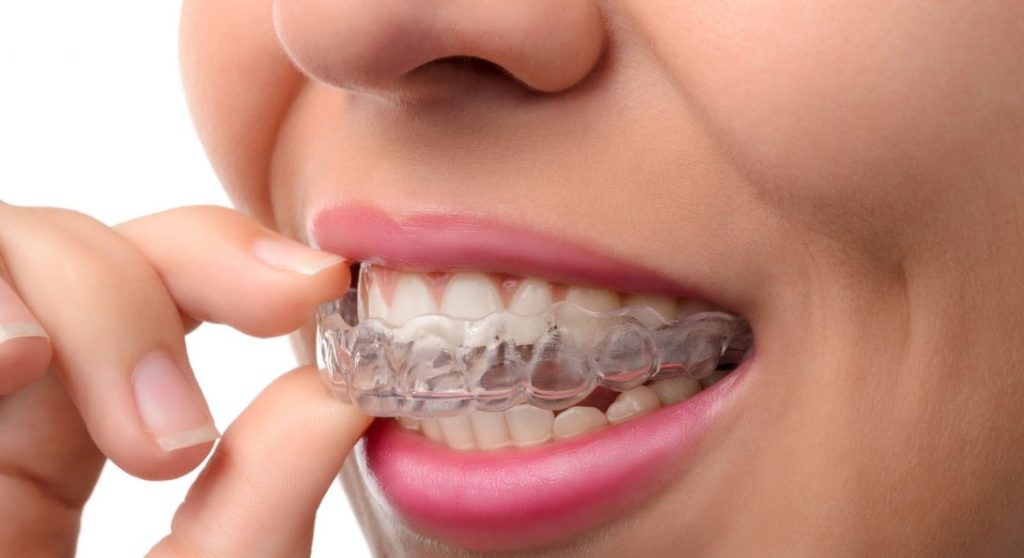 Invisible braces and teeth aligners in Paschim Vihar